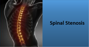 What is Spinal Stenosis? Causes,  Symptoms and Treatment Options