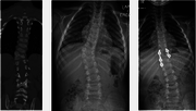  lumbar scoliosis | Consultant Spine Surgeon - Dr. Jwalant S Me