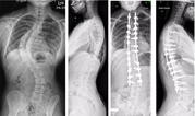 Dr Jwalant Mehta | Academia and Research |Best Spinal Deformity Surgeo