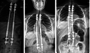 Dr Jwalant Mehta - Early Onset Scoliosis | Best Spinal Surgeons in UK