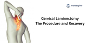Cervical Laminectomy - The Procedure and Recovery | Dr Jwalant S Mehta